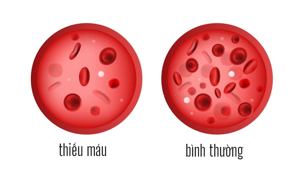thieu mau 1