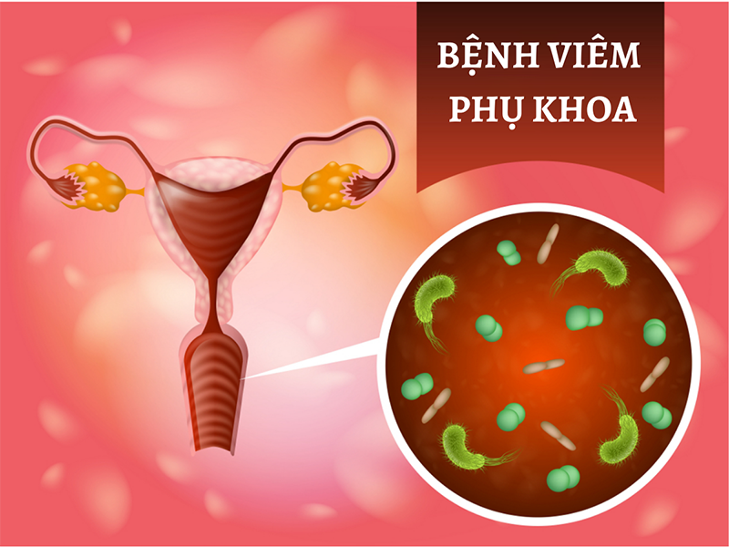 viem phu khoa