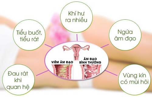 Những dấu hiệu cảnh báo “viêm phụ khoa” cần phòng ngừa và chữa trị kịp thời 1 viem phu khoa1